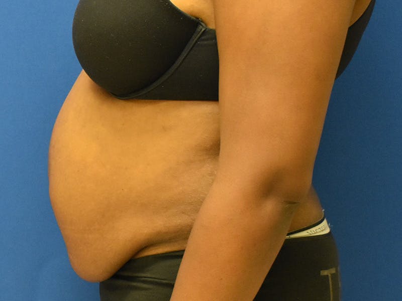 Tummy Tuck Before & After Gallery - Patient 129499488 - Image 7