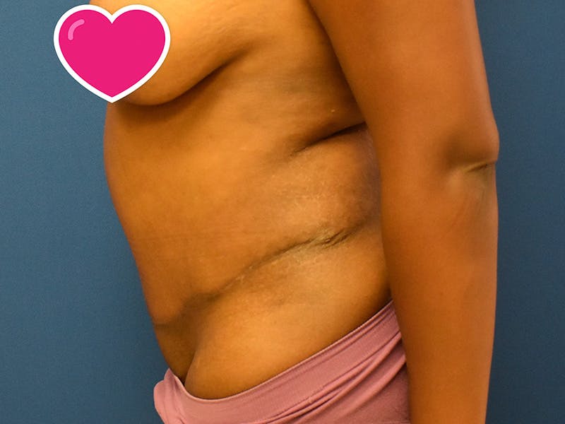 Tummy Tuck Before & After Gallery - Patient 129499488 - Image 8