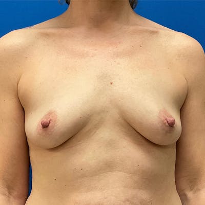 Breast Reconstruction Before & After Gallery - Patient 132945863 - Image 1