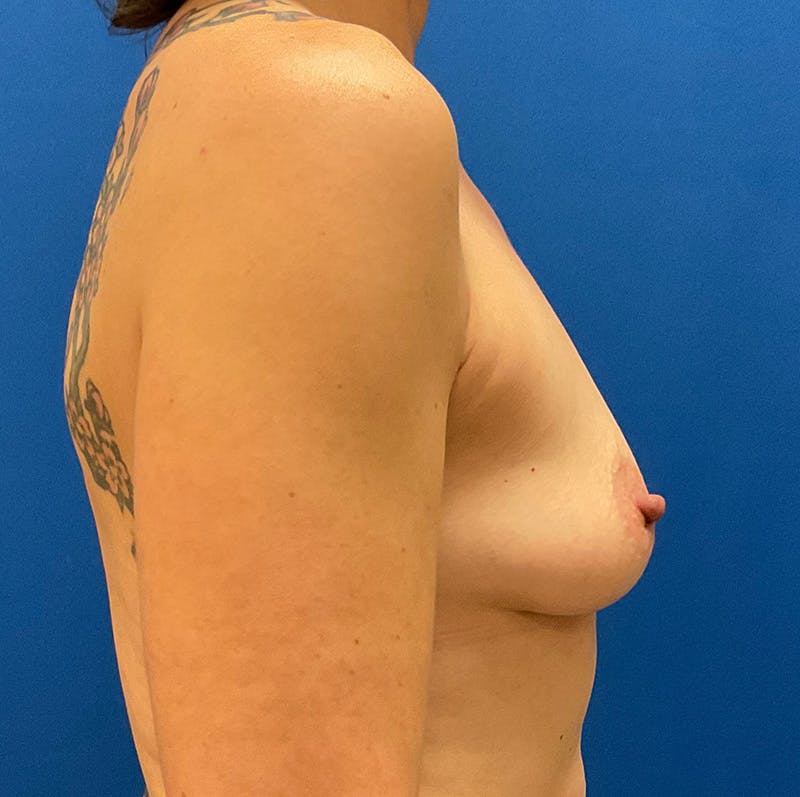 Breast Reconstruction Before & After Gallery - Patient 132945863 - Image 5