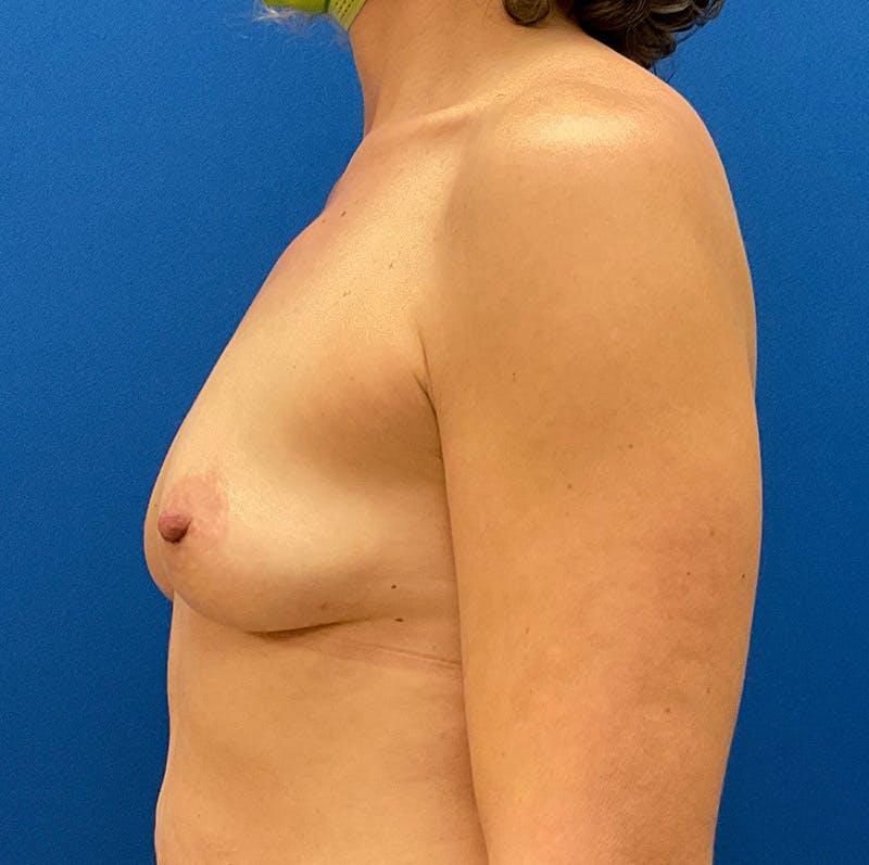 Breast Reconstruction Before & After Gallery - Patient 132945863 - Image 9