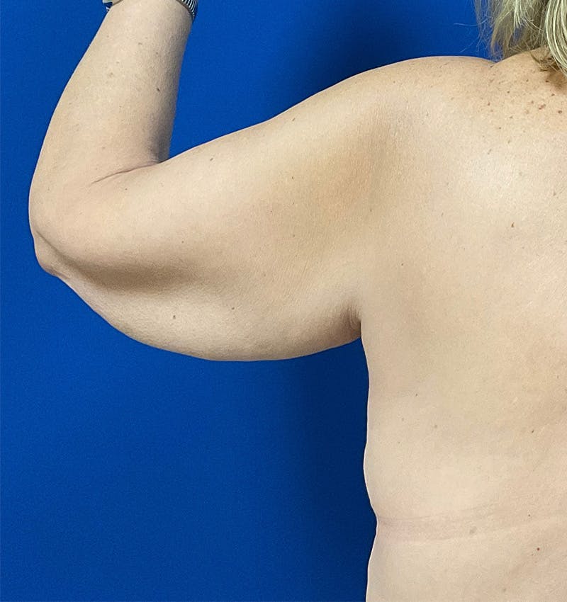 Arm Lift Before & After Gallery - Patient 157585746 - Image 3
