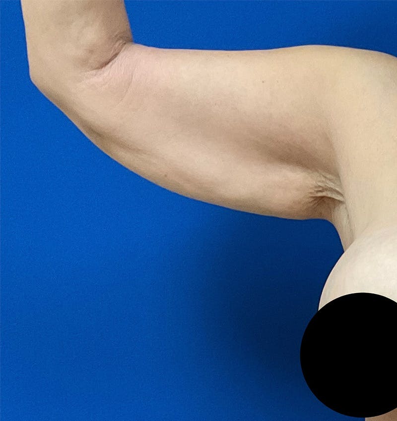 Arm Lift Before & After Gallery - Patient 157585746 - Image 5