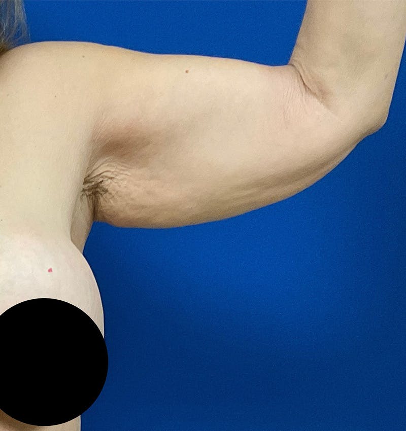 Arm Lift Before & After Gallery - Patient 157585746 - Image 7