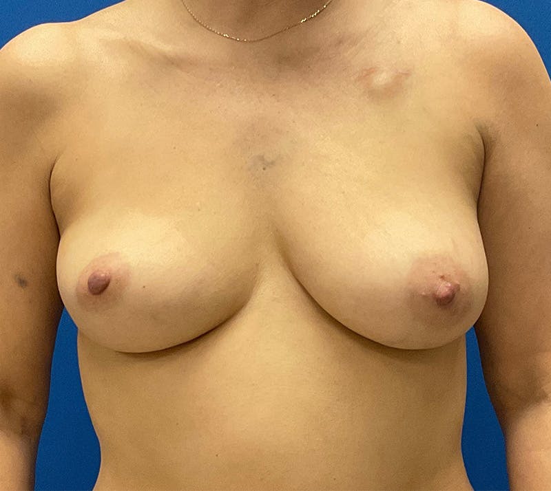 DIEP Flap Reconstruction Before & After Gallery - Patient 157587383 - Image 1