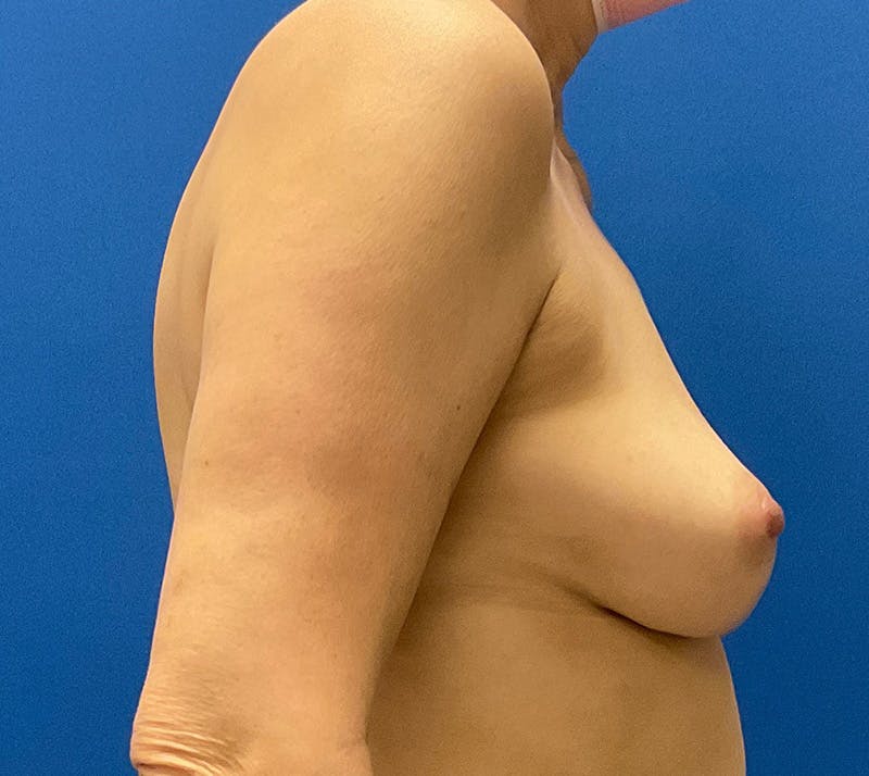 DIEP Flap Reconstruction Before & After Gallery - Patient 157587383 - Image 5