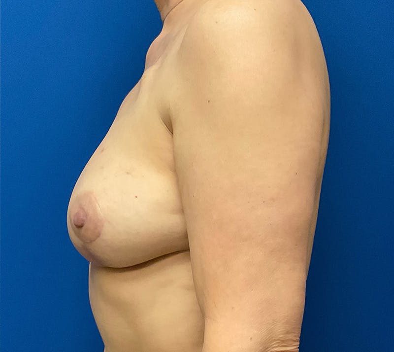 DIEP Flap Reconstruction Before & After Gallery - Patient 157587383 - Image 10