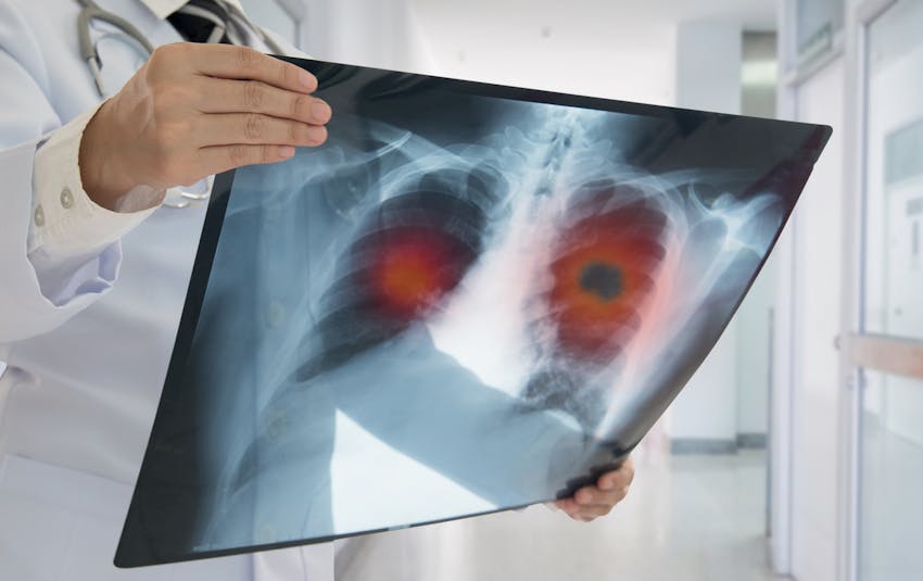 A doctor holding an xray of a lung