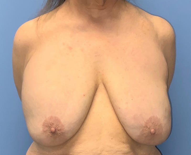 Breast Augmentation Before & After Gallery - Patient 148565731 - Image 1