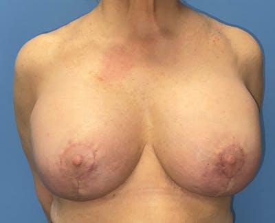 Breast Augmentation Before & After Gallery - Patient 148565731 - Image 2