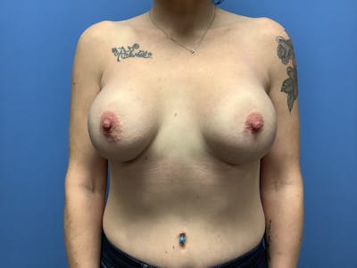 Breast Augmentation Before & After Gallery - Patient 148565732 - Image 2