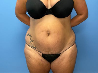 Tummy Tuck Before & After Gallery - Patient 148565803 - Image 1