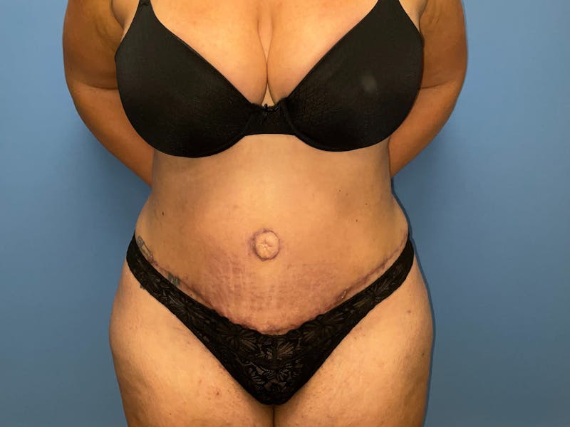 Tummy Tuck Before & After Gallery - Patient 148565803 - Image 2
