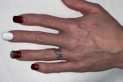 Tattoo Removal Before & After Gallery - Patient 155788854 - Image 1
