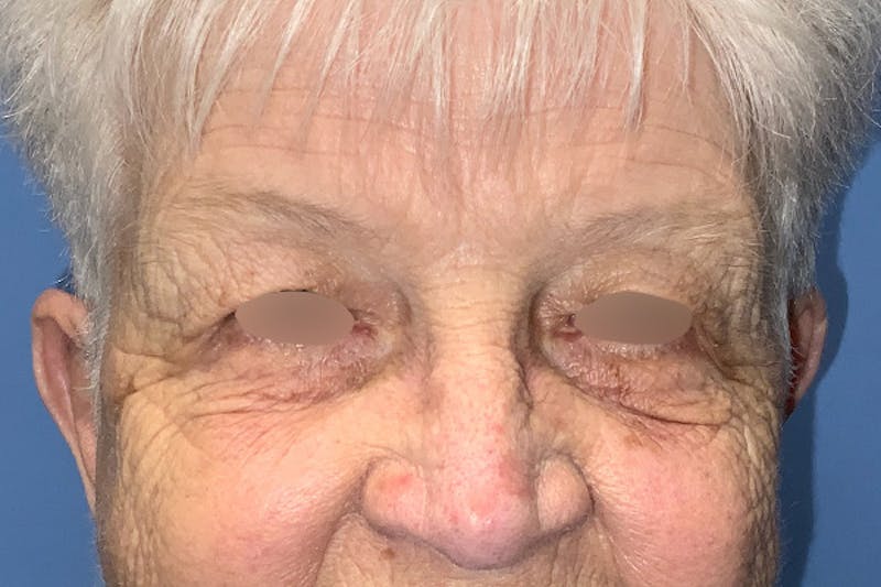 Blepharoplasty Before & After Gallery - Patient 155788861 - Image 1