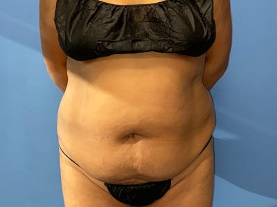 Tummy Tuck Before & After Gallery - Patient 172948885 - Image 1