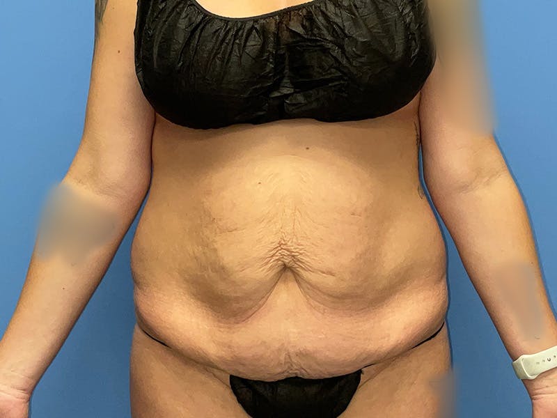 Tummy Tuck Before & After Gallery - Patient 175541478 - Image 1