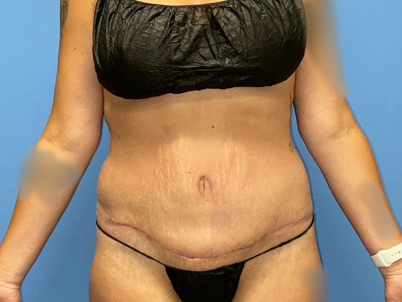 Tummy Tuck Before & After Gallery - Patient 175541478 - Image 2