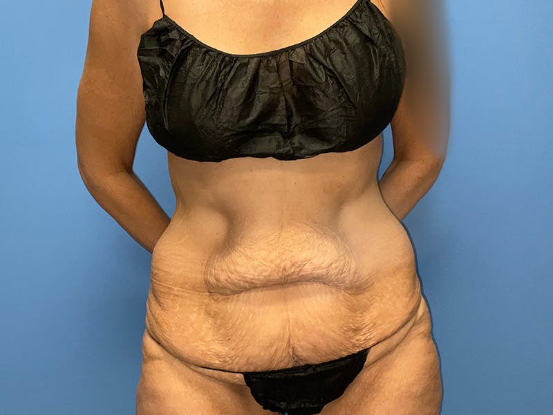 Tummy Tuck Before & After Gallery - Patient 175541477 - Image 1