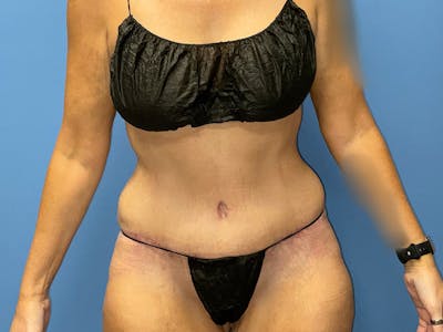 Tummy Tuck Before & After Gallery - Patient 175541477 - Image 2