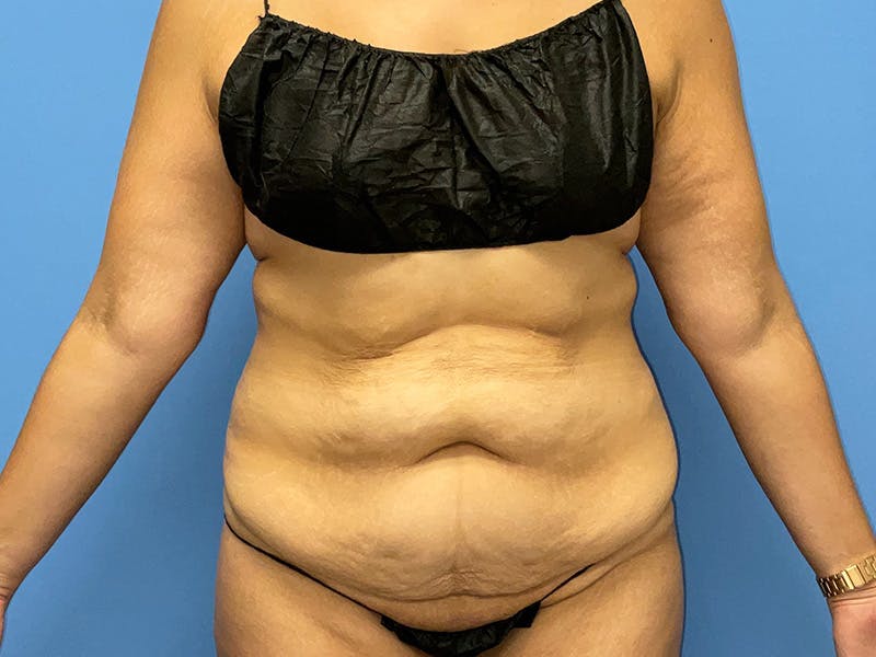Tummy Tuck Before & After Gallery - Patient 175541476 - Image 1
