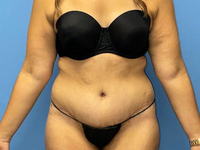 Tummy Tuck Before & After Gallery - Patient 175541476 - Image 2