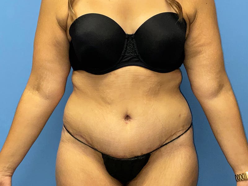 Tummy Tuck Before & After Gallery - Patient 175541476 - Image 2