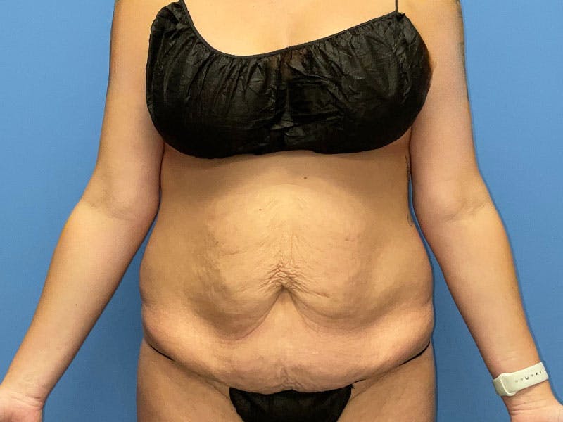 Tummy Tuck Before & After Gallery - Patient 184893039 - Image 1
