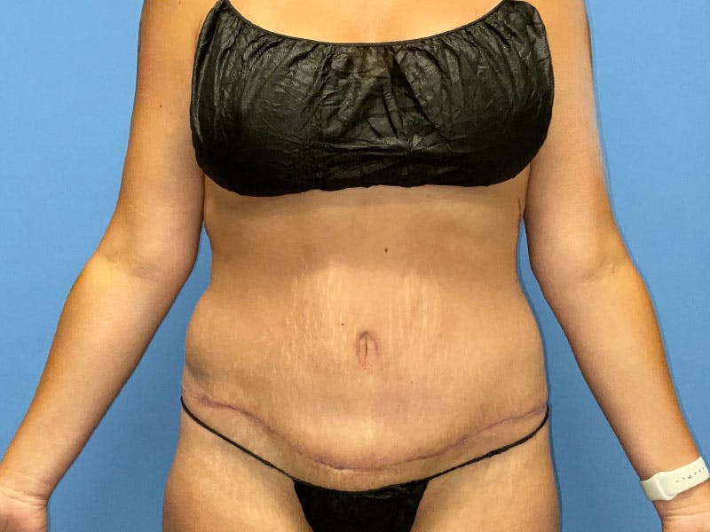 Tummy Tuck Before & After Gallery - Patient 184893039 - Image 2