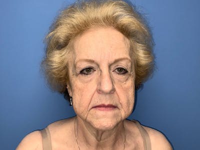 Facelift Before & After Gallery - Patient 184893079 - Image 1