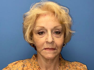 Facelift Before & After Gallery - Patient 184893079 - Image 2