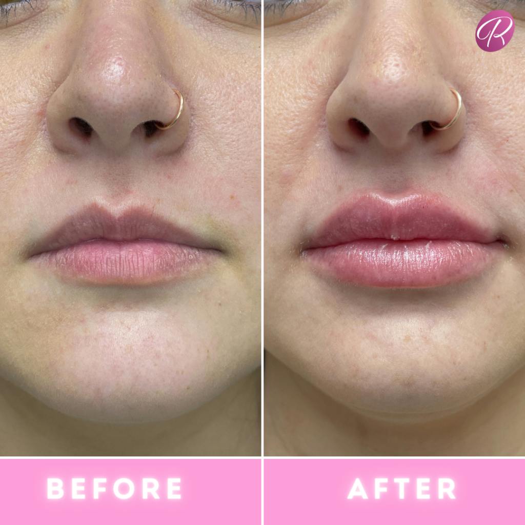 Fillers Before & After Gallery - Patient 86641190 - Image 1
