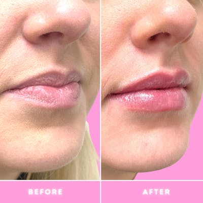 Fillers Before & After Gallery - Patient 86641192 - Image 1