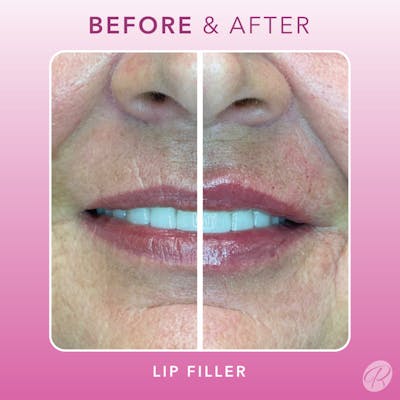 Fillers Before & After Gallery - Patient 86641193 - Image 1