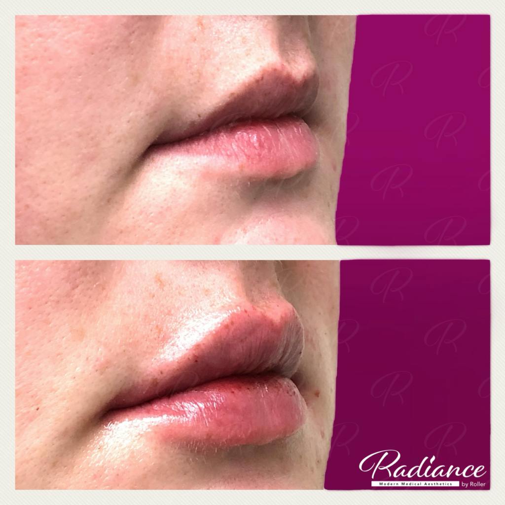 Fillers Before & After Gallery - Patient 86641194 - Image 1