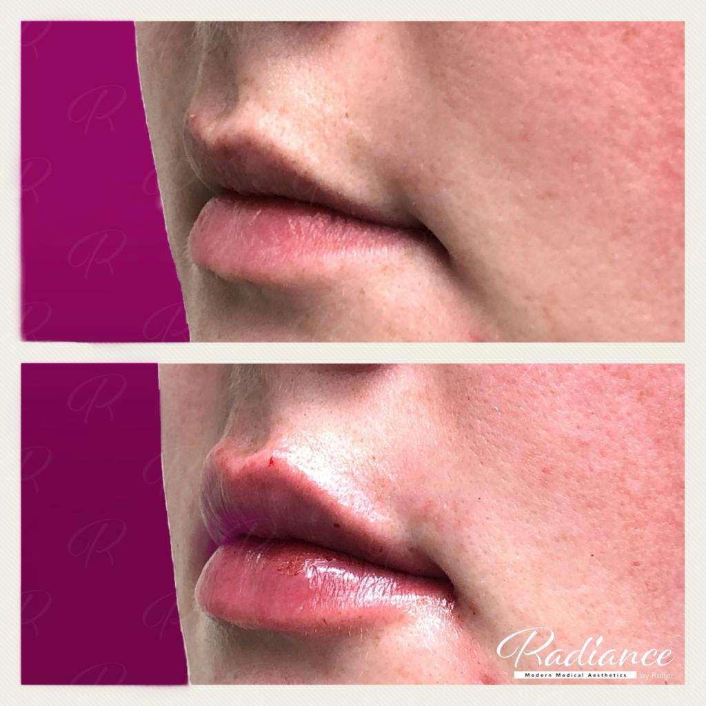 Fillers Before & After Gallery - Patient 86641194 - Image 2