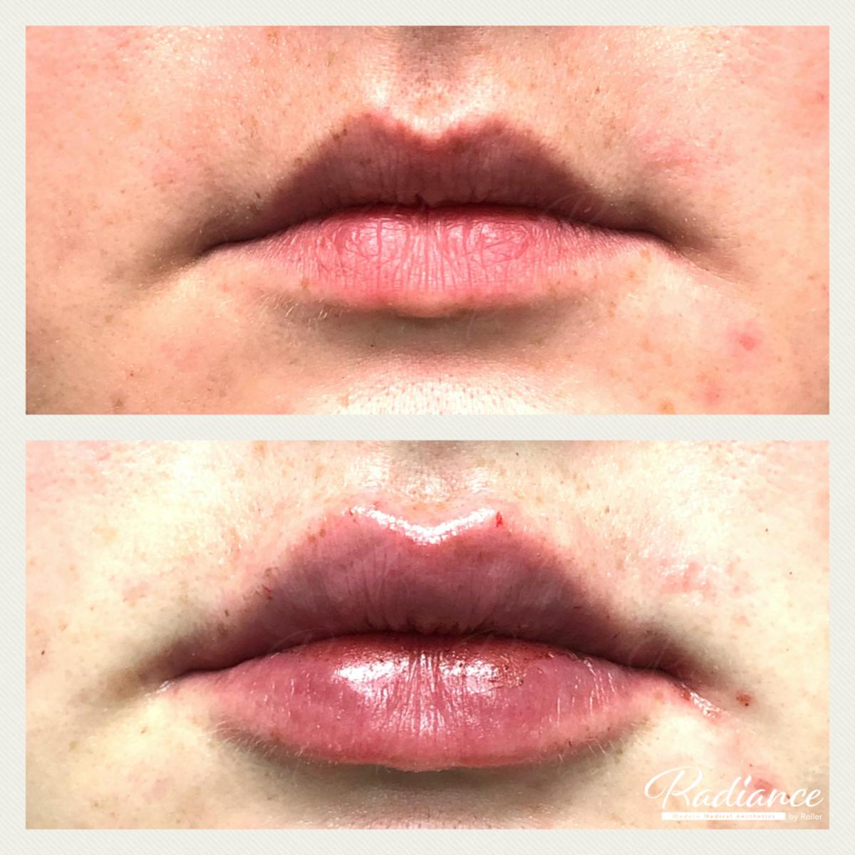 Fillers Before & After Gallery - Patient 86641194 - Image 3