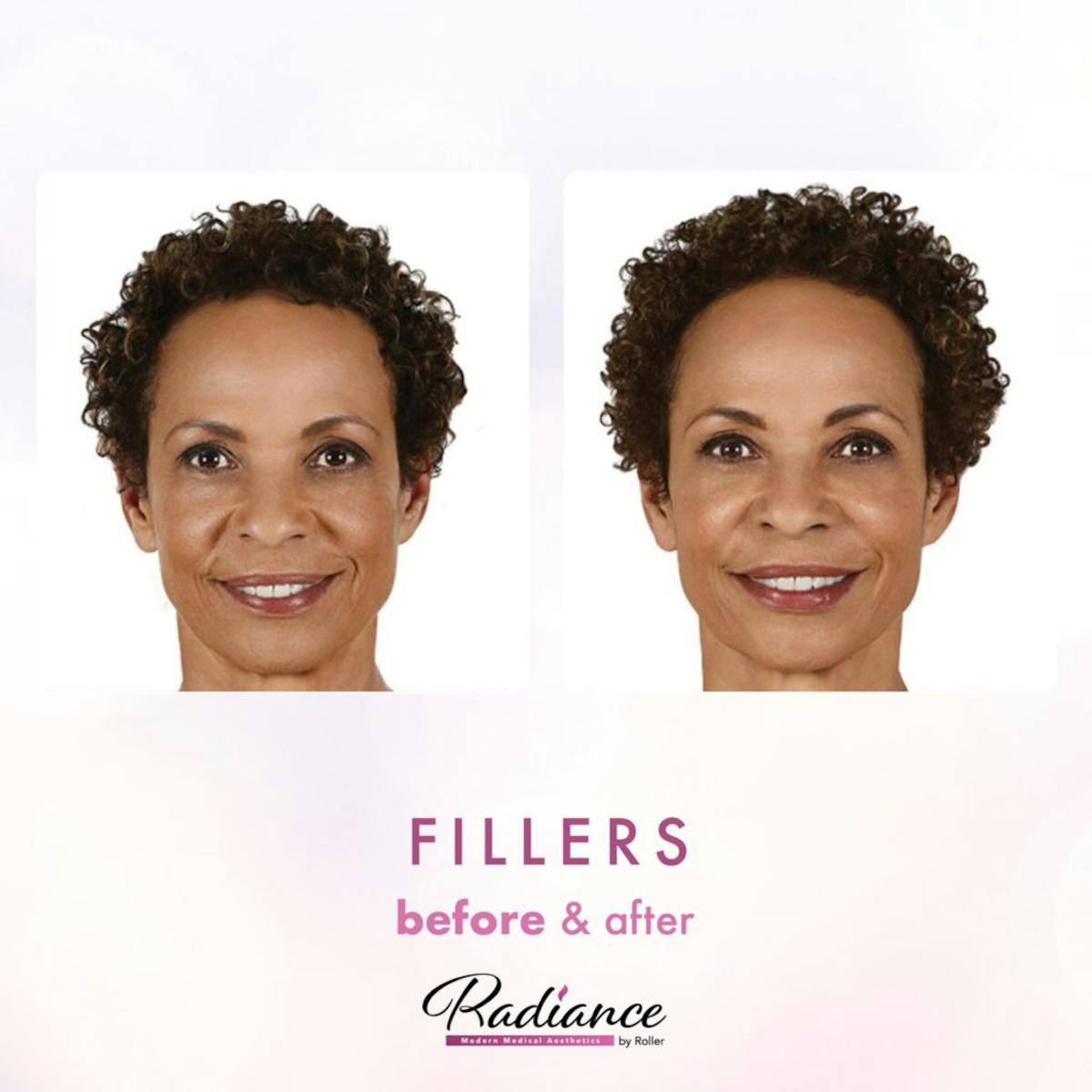 Fillers Before & After Gallery - Patient 86641197 - Image 1