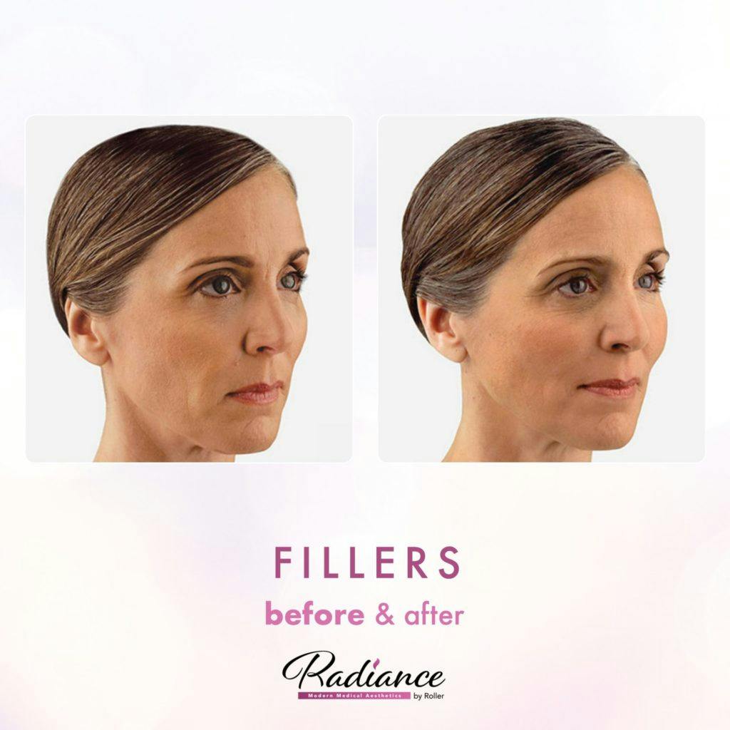 Fillers Before & After Gallery - Patient 86641198 - Image 1