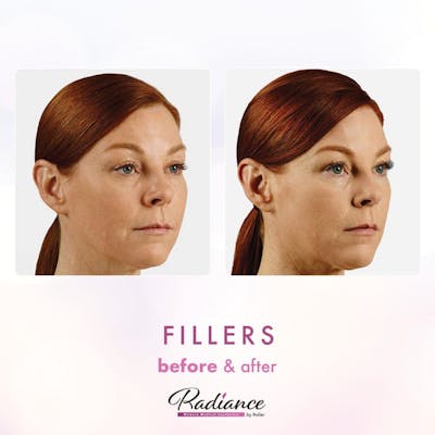 Fillers Before & After Gallery - Patient 86641200 - Image 1