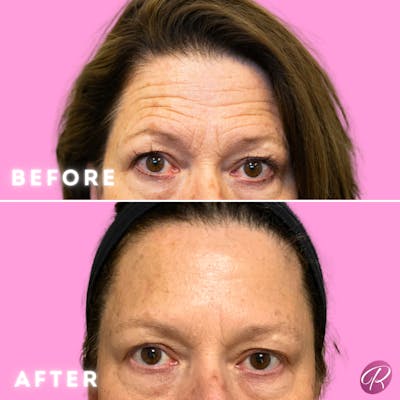 BOTOX Cosmetic Before & After Gallery - Patient 86641203 - Image 1