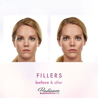 Fillers Before & After Gallery - Patient 86641201 - Image 1