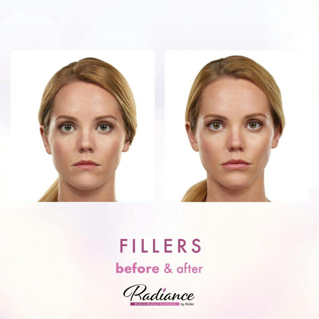 Fillers Before & After Gallery - Patient 86641201 - Image 1