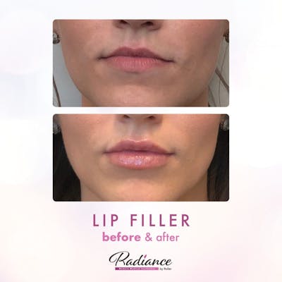 Fillers Before & After Gallery - Patient 86641204 - Image 1