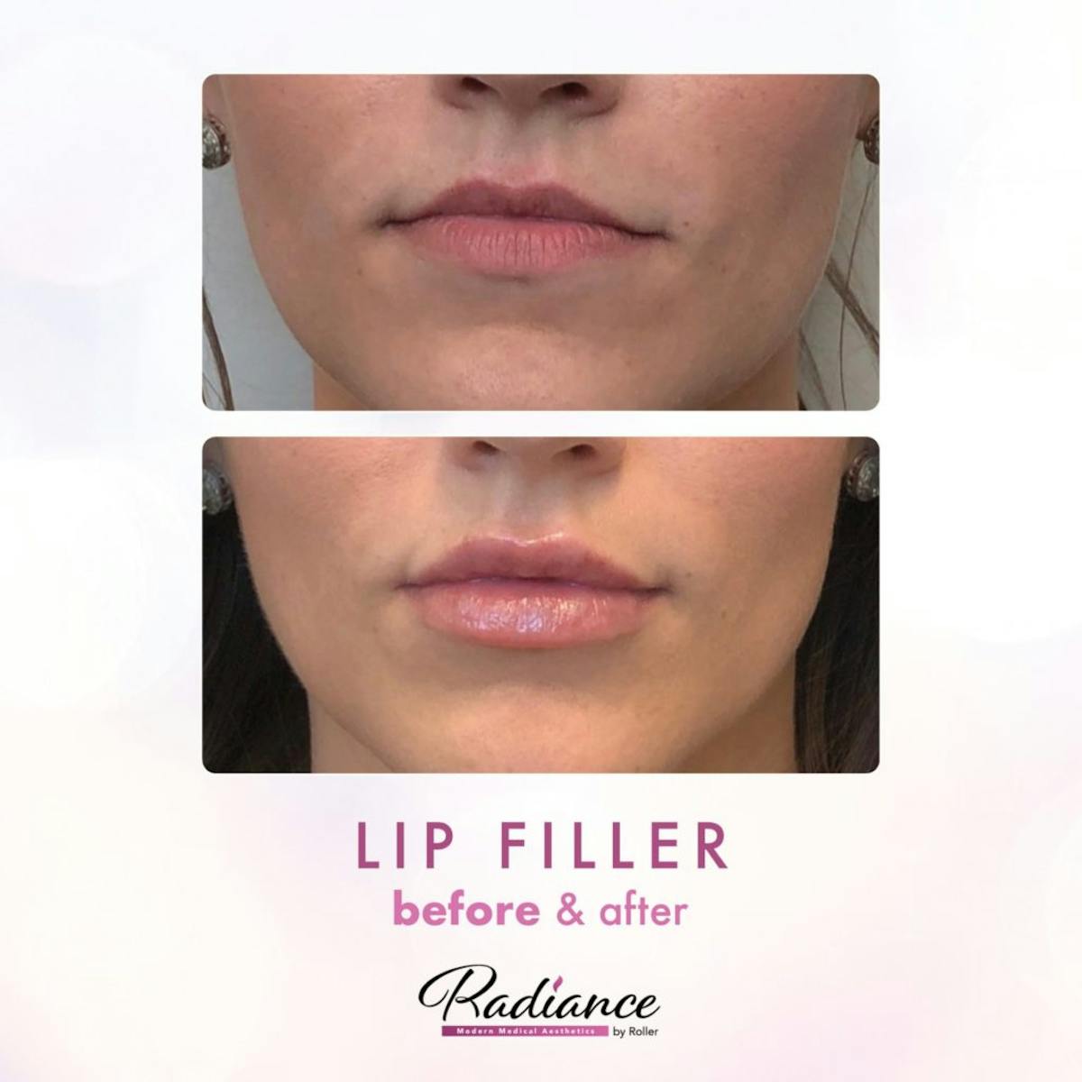 Fillers Before & After Gallery - Patient 86641204 - Image 1