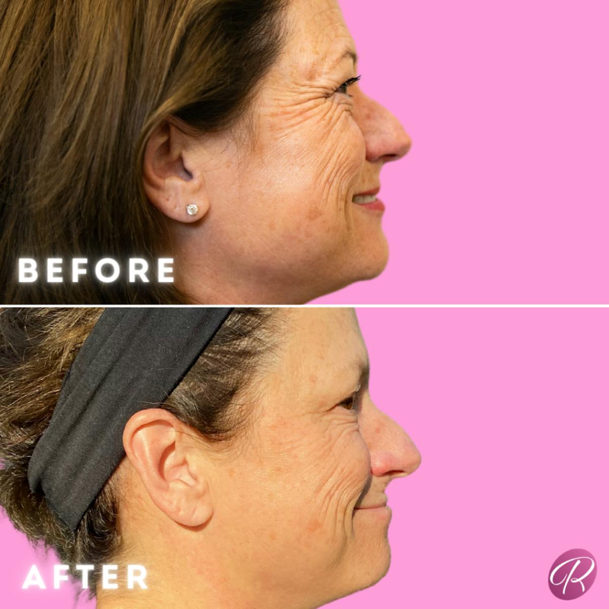 BOTOX Cosmetic Before & After Gallery - Patient 86641203 - Image 2