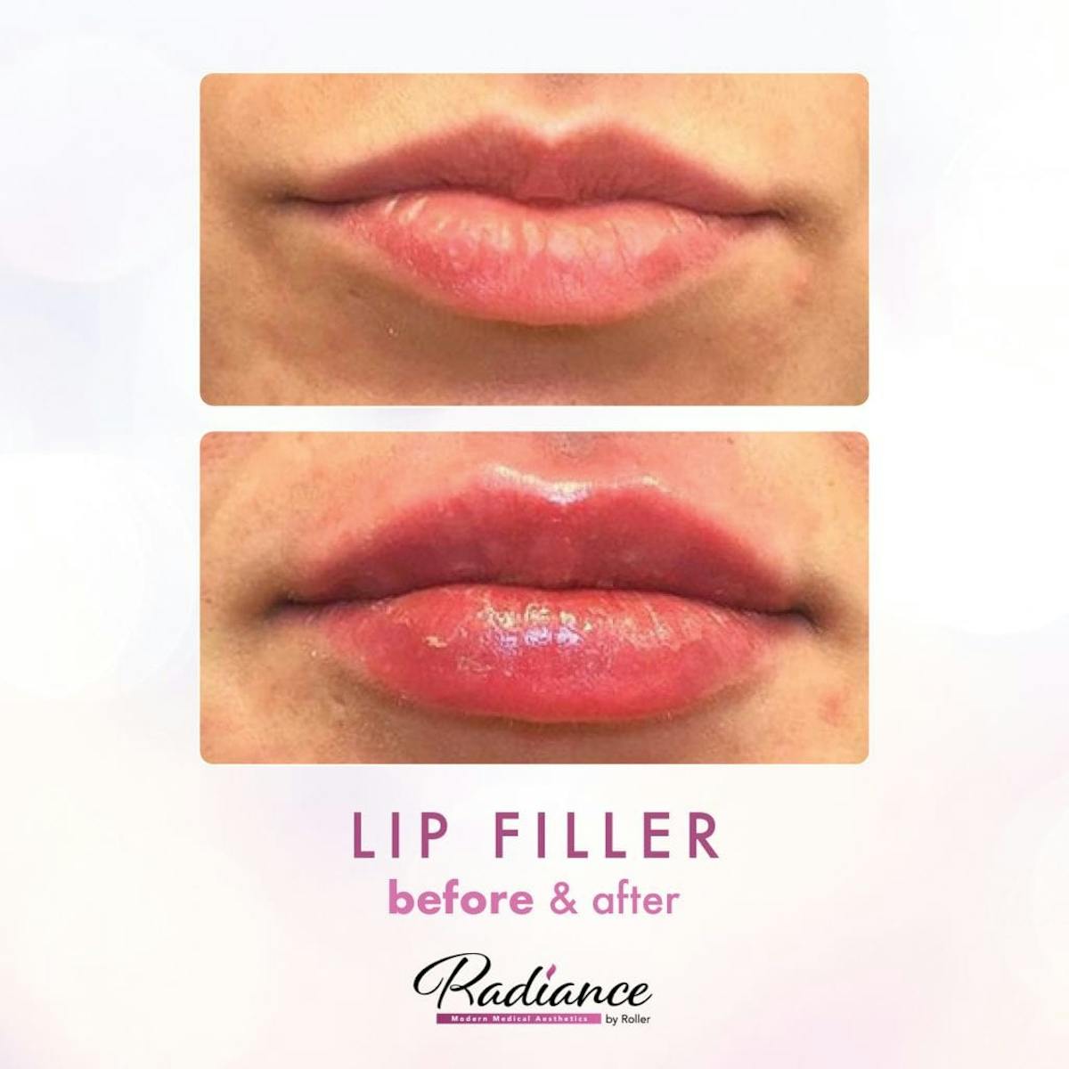 Fillers Before & After Gallery - Patient 86641206 - Image 1