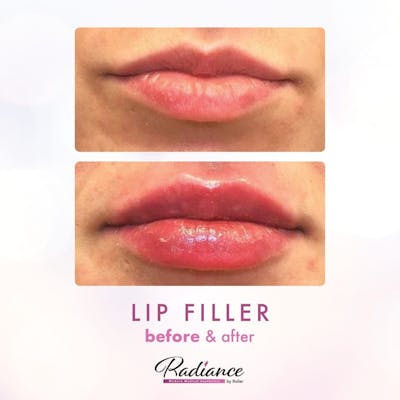 Fillers Before & After Gallery - Patient 86641206 - Image 1