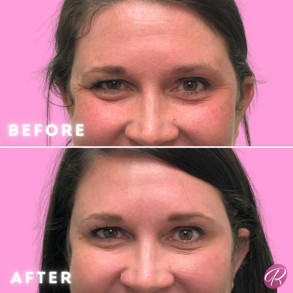 BOTOX Cosmetic Before & After Gallery - Patient 86641208 - Image 1