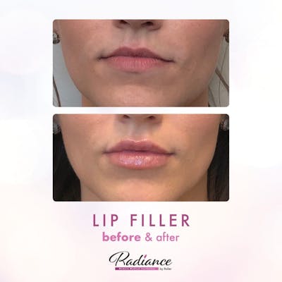 Fillers Before & After Gallery - Patient 86641207 - Image 1